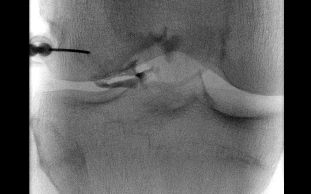 Autres infiltrations