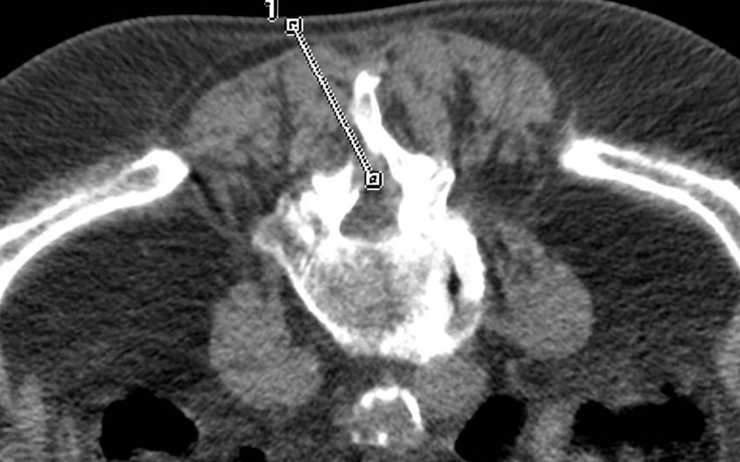 Infiltration épidurale