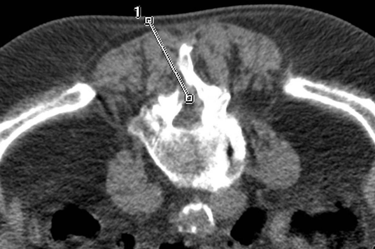 Infiltration épidurale Centre de radiologie Radiopole Artois