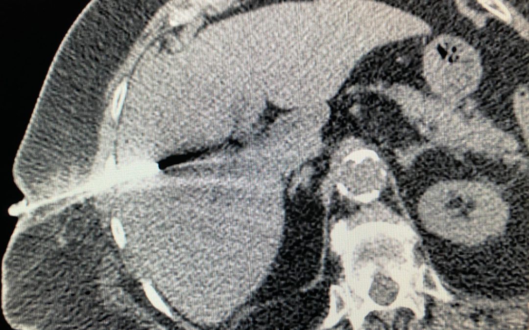 Ponction biopsie abdominale